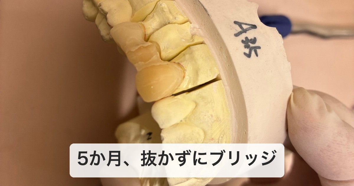 根管治療の後、抜かずに入った前歯ブリッジの石膏模型